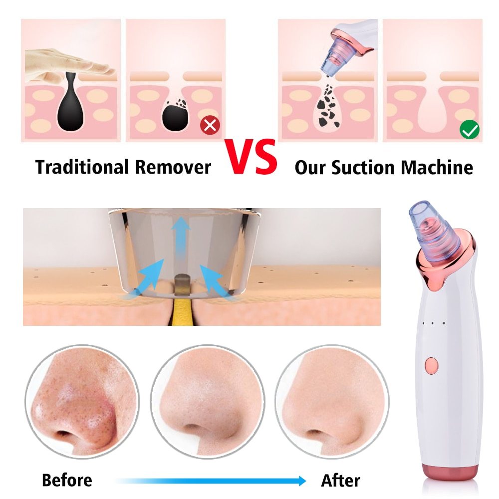 Electric Blackhead Remover – Advanced Facial Cleansing Tool